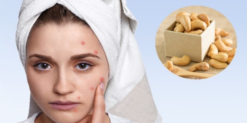 Ăn hạt điều rang muối có nổi mụn không?